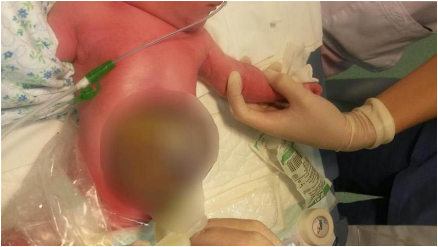 В «Хадассе» вылечили ребенка, родившегося с кишечником наружу