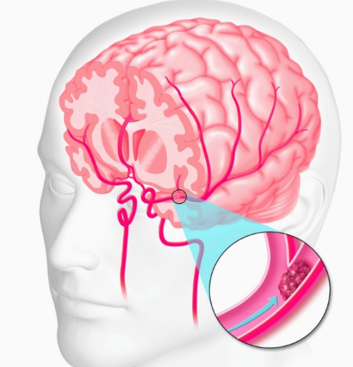 Сосудистый центр головного мозга. Инсульт и киста в голове.
